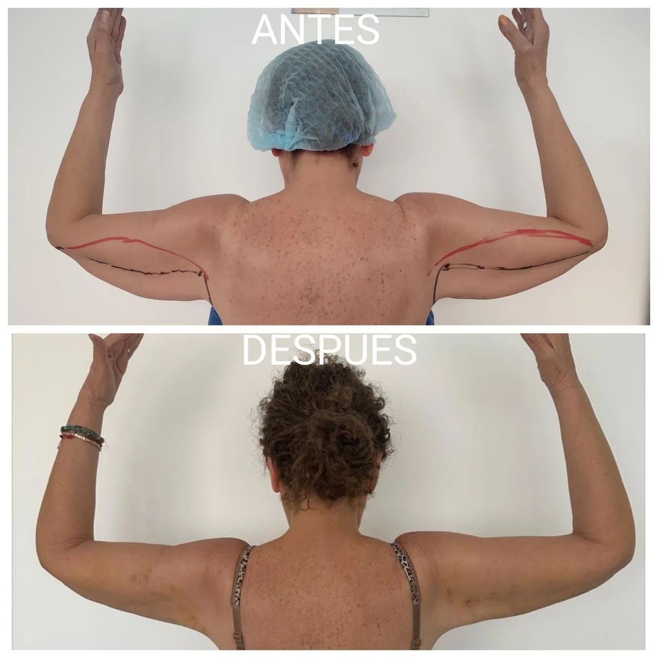 Resultado real de lipólisis láser: Contorno de brazos, antes y después