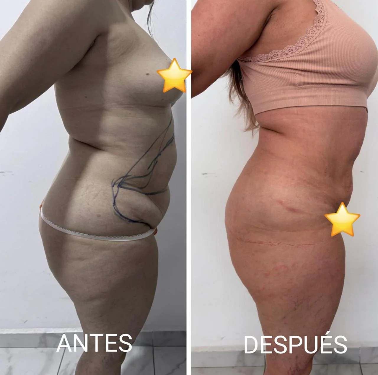 Resultado real de lipólisis láser: Perfil abdominal, antes y después